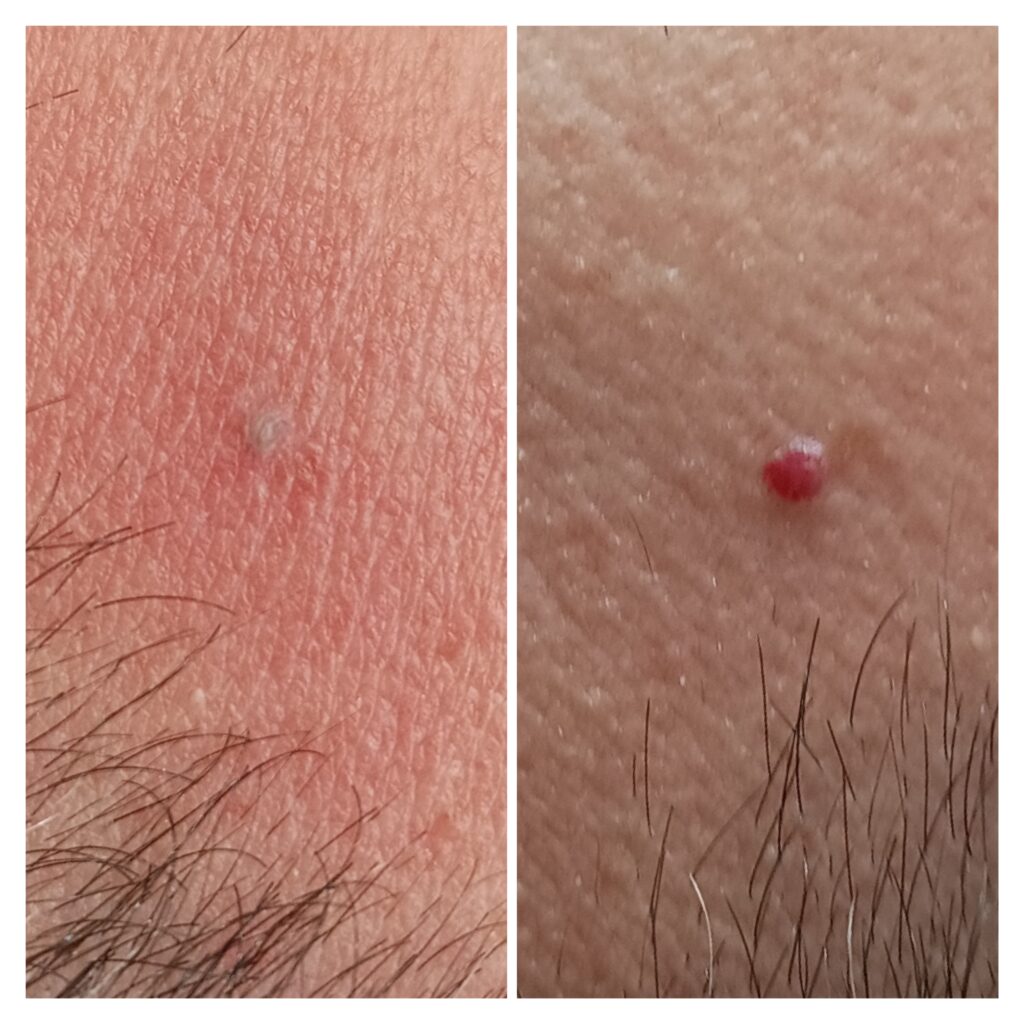 Zamykanie Naczynek  Znamion Rubinowych Bydgoszcz 09